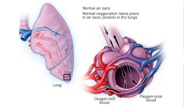 Risk of Pulmonary Edema