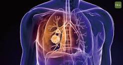 Pulmonary Edema（2）